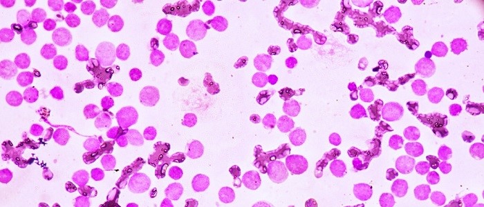 Acute Myeloid Leukaemia cells under a microscope