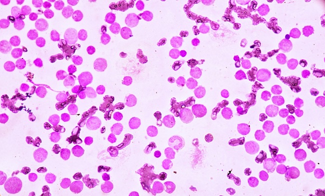Acute Myeloid Leukaemia cells under a microscope