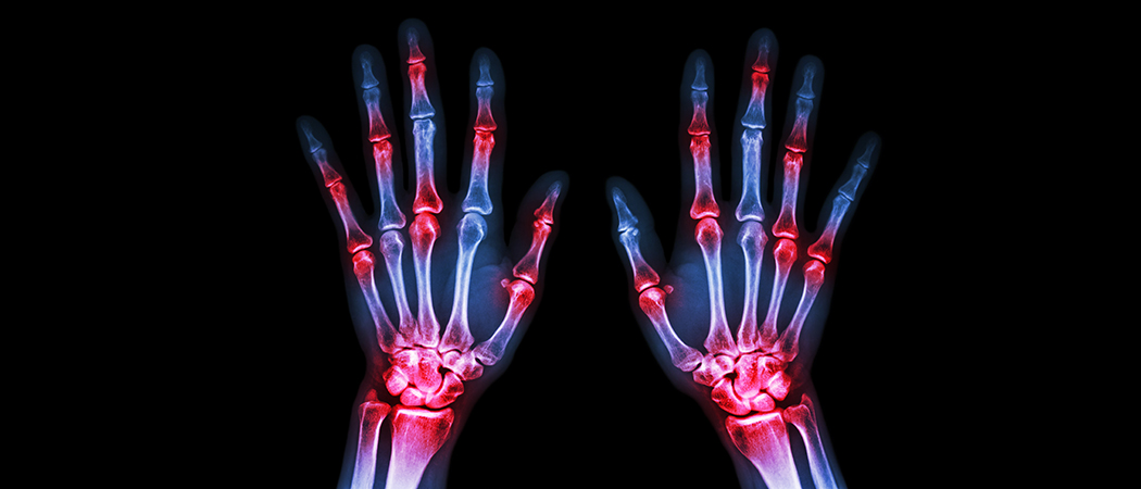 Psoriatic Arthritis x-ray
